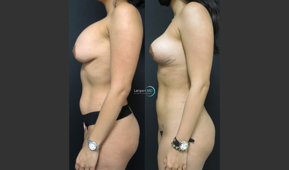 Breast Explant Before & After Gallery - Patient 122908837 - Image 3