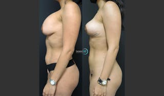 Breast Explant Before & After Gallery - Patient 122908837 - Image 3