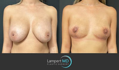 Breast Explant Before & After Gallery - Patient 148735012 - Image 1