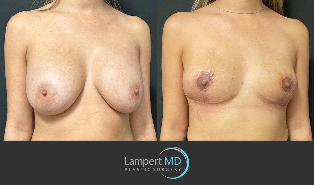 Breast Explant Before & After Gallery - Patient 148735012 - Image 2
