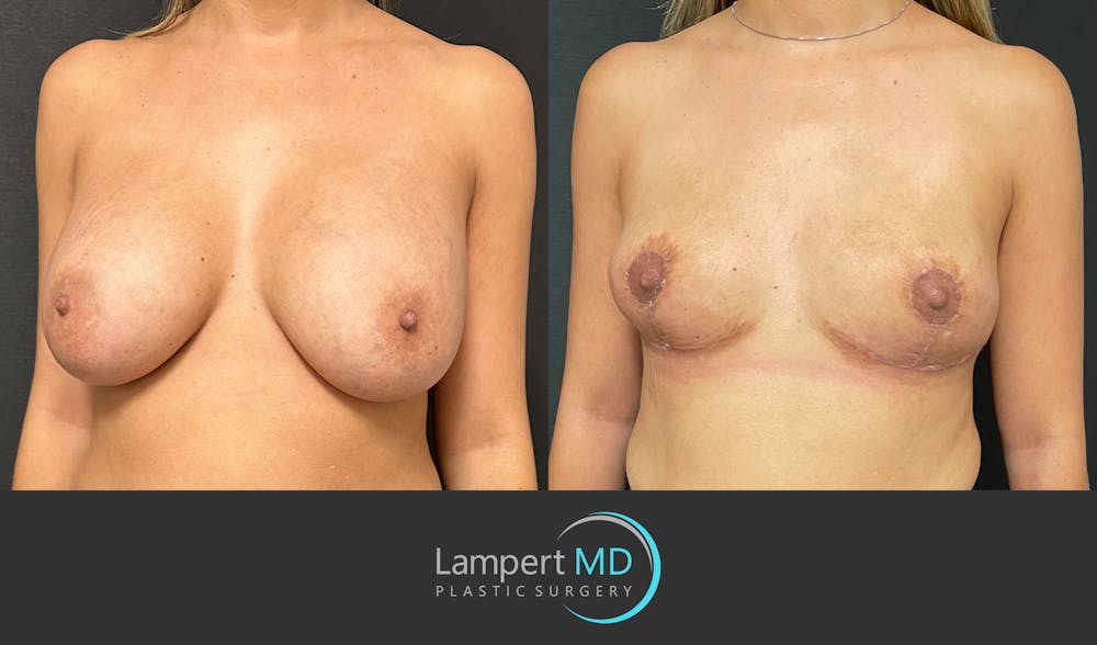 Breast Explant Before & After Gallery - Patient 148735012 - Image 3