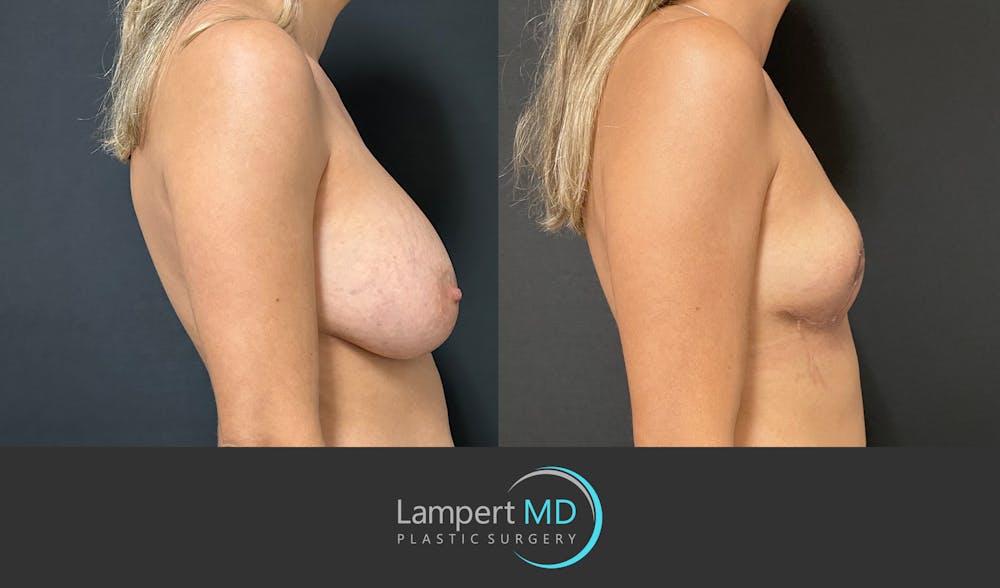 Breast Explant Before & After Gallery - Patient 148735012 - Image 4