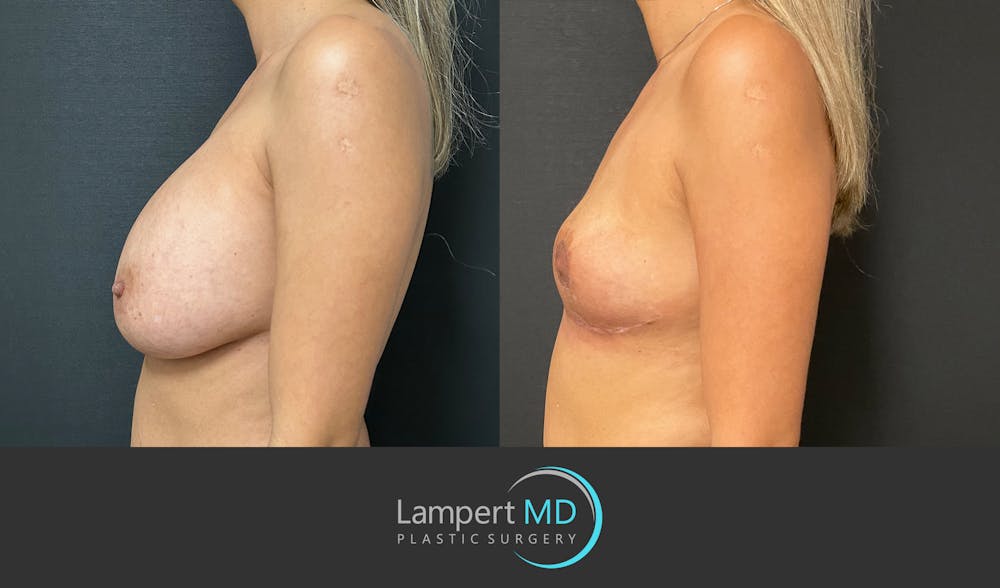 Breast Explant Before & After Gallery - Patient 148735012 - Image 5