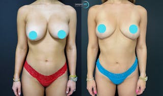 Breast Fat Transfer Before & After Gallery - Patient 402141 - Image 1