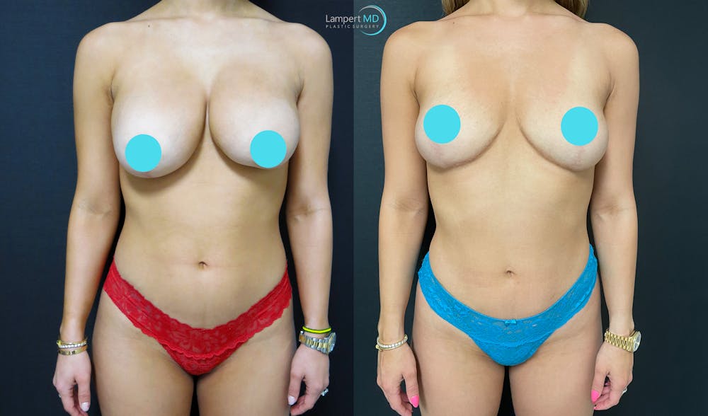 Breast Explant Before & After Gallery - Patient 146131718 - Image 1