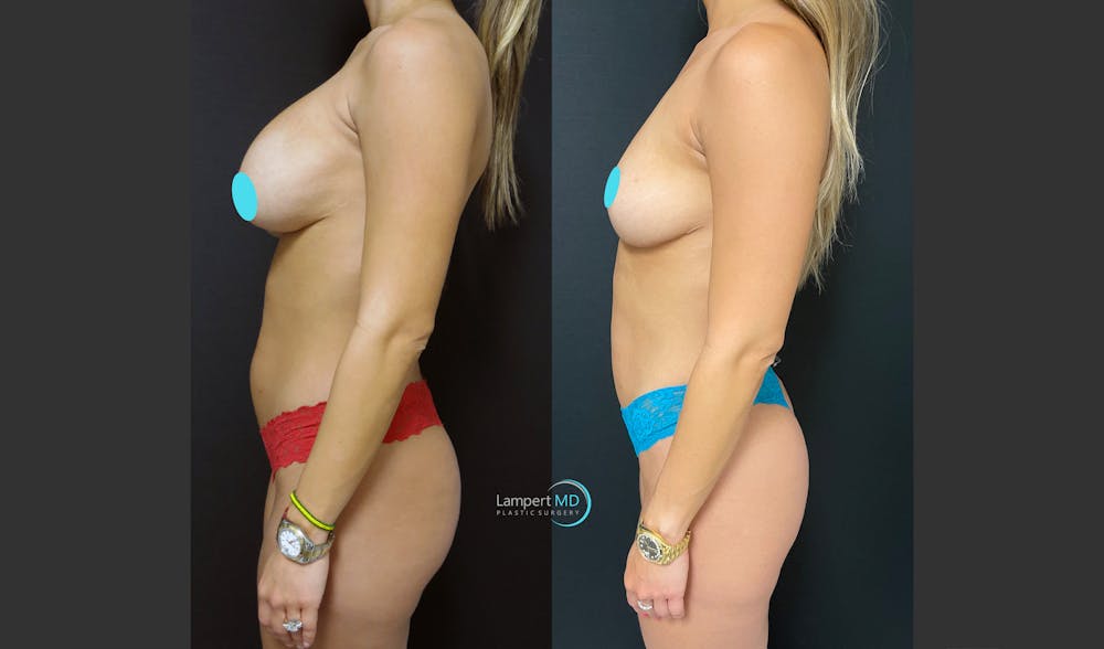 Breast Explant Before & After Gallery - Patient 146131718 - Image 4