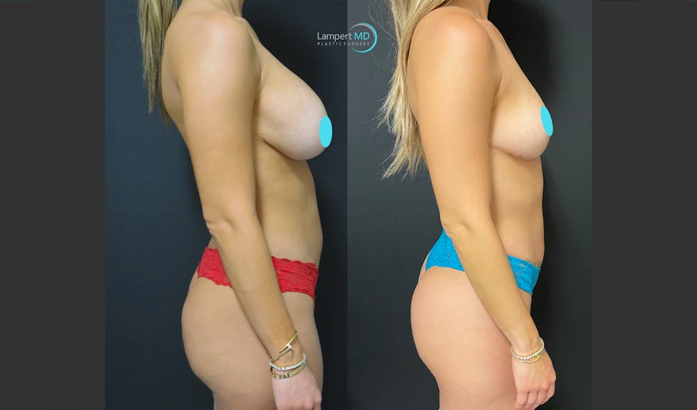 Breast Fat Transfer Before & After Gallery - Patient 402141 - Image 5