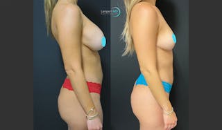 Breast Explant Before & After Gallery - Patient 146131718 - Image 5