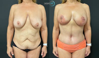 Mommy Makeover Before & After Gallery - Patient 143556229 - Image 1