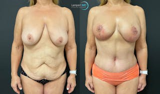 Mommy Makeover Before & After Gallery - Patient 143556229 - Image 1