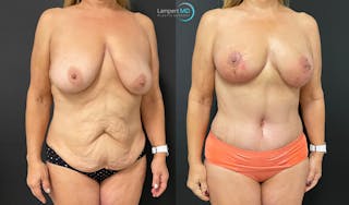 Mommy Makeover Before & After Gallery - Patient 143556229 - Image 2