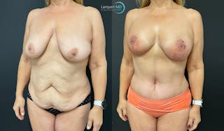 Mommy Makeover Before & After Gallery - Patient 143556229 - Image 3