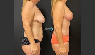 Mommy Makeover Before & After Gallery - Patient 143556229 - Image 4