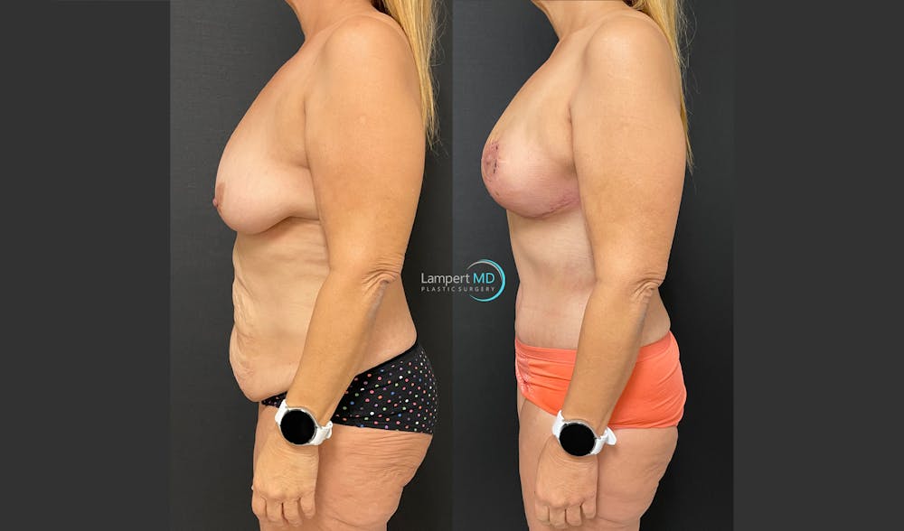 Mommy Makeover Before & After Gallery - Patient 143556229 - Image 5