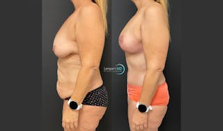 Mommy Makeover Before & After Gallery - Patient 143556229 - Image 5
