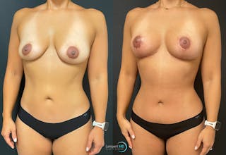 Mommy Makeover Before & After Gallery - Patient 148758156 - Image 2
