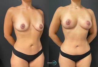 Mommy Makeover Before & After Gallery - Patient 148758156 - Image 3