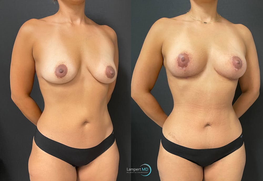 Mommy Makeover Before & After Gallery - Patient 148758156 - Image 3