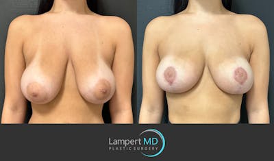 Breast Lift Before & After Gallery - Patient 151885214 - Image 1
