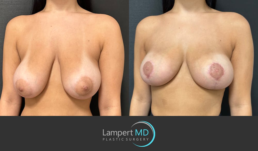 Breast Reduction Before & After Gallery - Patient 149097890 - Image 2