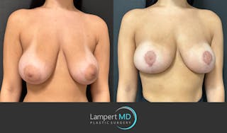 Breast Reduction Before & After Gallery - Patient 149097890 - Image 3