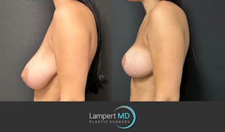 Breast Reduction Before & After Gallery - Patient 149097890 - Image 4