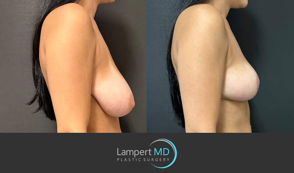 Breast Reduction Before & After Gallery - Patient 149097890 - Image 5