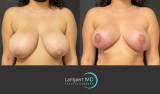 Breast Reduction Before & After Gallery - Patient 149097913 - Image 1