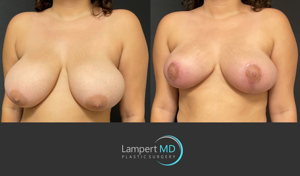 Breast Reduction Before & After Gallery - Patient 149097913 - Image 2