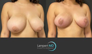 Breast Reduction Before & After Gallery - Patient 149097913 - Image 3