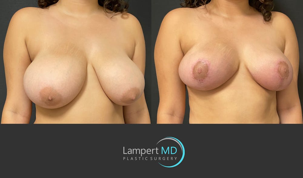 Breast Reduction Before & After Gallery - Patient 149097913 - Image 3