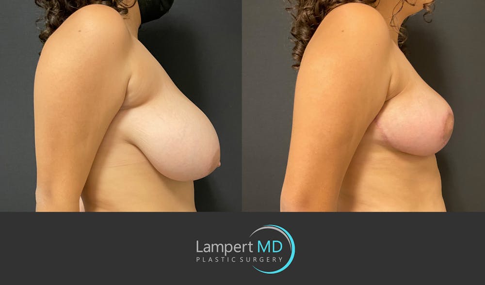 Breast Reduction Before & After Gallery - Patient 149097913 - Image 4