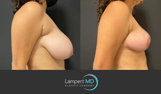 Breast Reduction Before & After Gallery - Patient 149097913 - Image 4