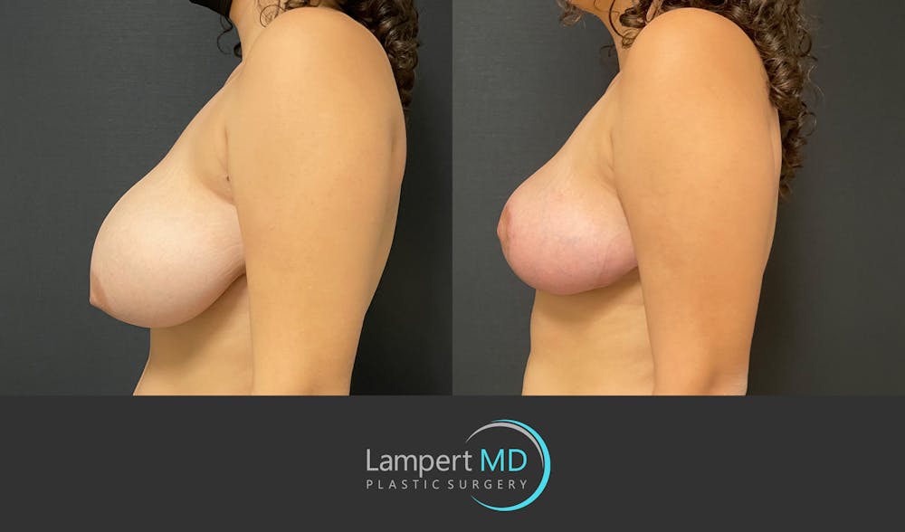 Breast Reduction Before & After Gallery - Patient 149097913 - Image 5