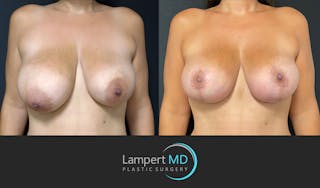 Breast Lift Before & After Gallery - Patient 143576352 - Image 1