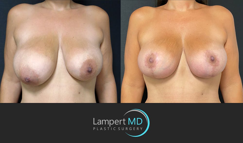 Breast Reduction Before & After Gallery - Patient 149097912 - Image 1