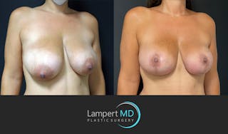 Breast Lift Before & After Gallery - Patient 143576352 - Image 2