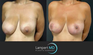 Breast Lift Before & After Gallery - Patient 143576352 - Image 3