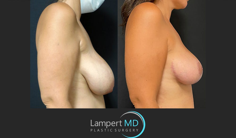 Breast Reduction Before & After Gallery - Patient 149097912 - Image 4