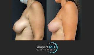Breast Reduction Before & After Gallery - Patient 149097912 - Image 5