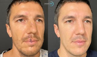 Nasal Fracture Before & After Gallery - Patient 149147927 - Image 2