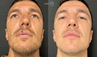 Nasal Fracture Before & After Gallery - Patient 149147927 - Image 3