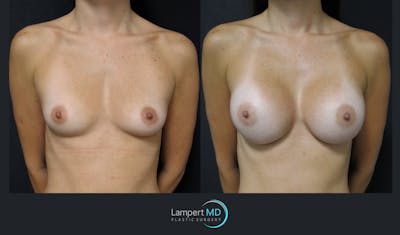 Breast Augmentation Before & After Gallery - Patient 149147944 - Image 1