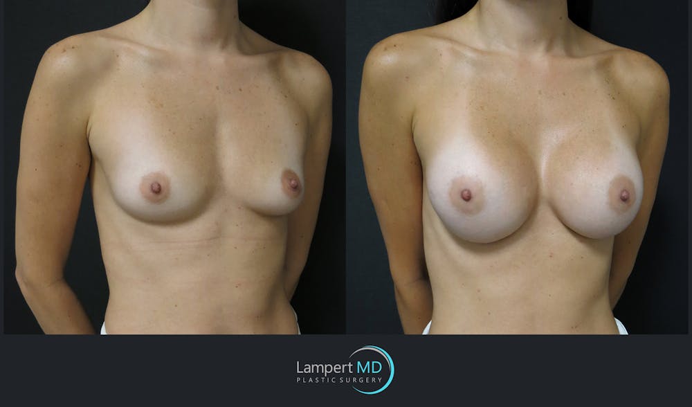 Breast Augmentation Before & After Gallery - Patient 149147944 - Image 2