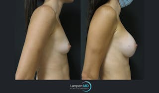 Breast Augmentation Before & After Gallery - Patient 149147944 - Image 3