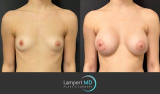 Breast Augmentation Before & After Gallery - Patient 149385048 - Image 1