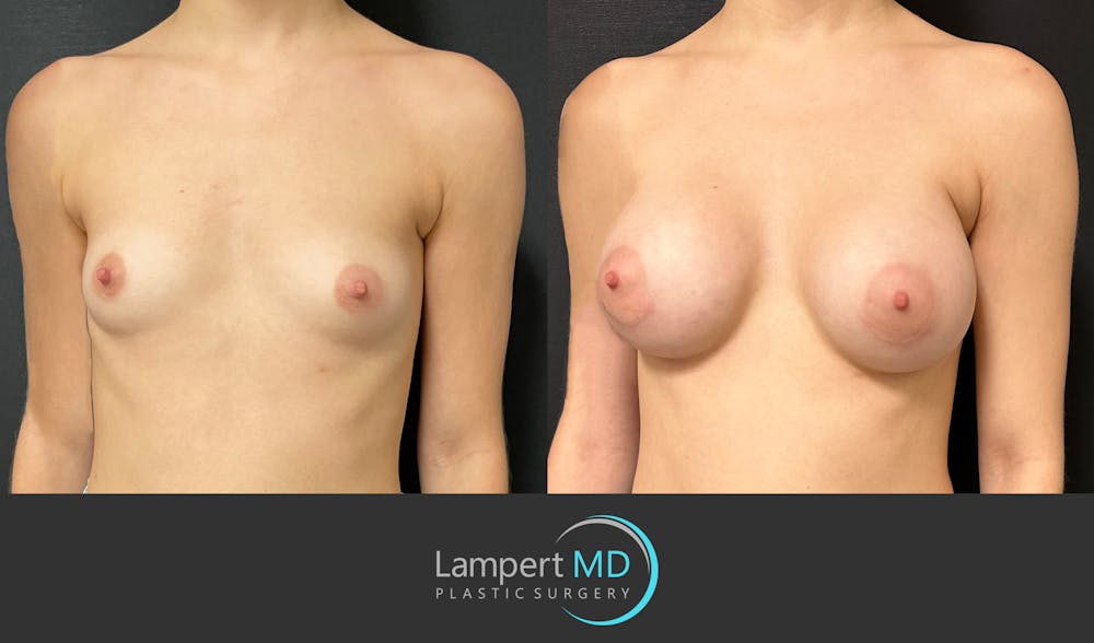 Breast Augmentation Before & After Gallery - Patient 149385048 - Image 2