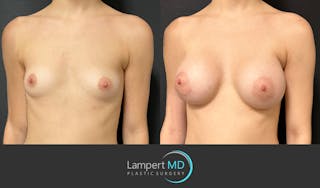 Breast Augmentation Before & After Gallery - Patient 149385048 - Image 2