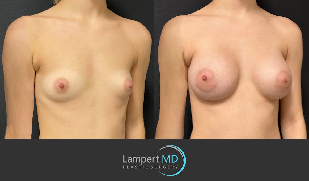 Breast Augmentation Before & After Gallery - Patient 149385048 - Image 3