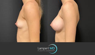 Breast Augmentation Before & After Gallery - Patient 149385048 - Image 4